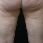 Cellulite Treatment Before & After Patient #1549