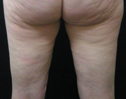 Cellulite Treatment Before & After Patient #1549