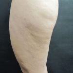 Cellulite Treatment Before & After Patient #1543