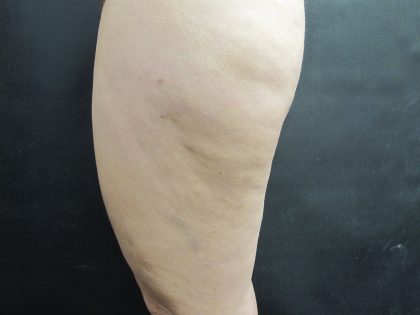 Cellulite Treatment Before & After Patient #1543