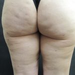 Cellulite Treatment Before & After Patient #1546