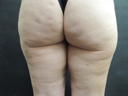 Cellulite Treatment Before & After Patient #1546