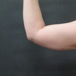 Liposuction Before & After Patient #936