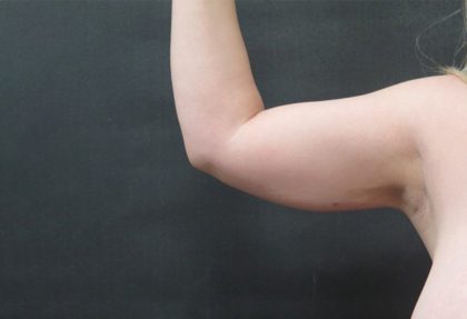 Liposuction Before & After Patient #936
