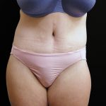 Lower Body Lift Before & After Patient #2285