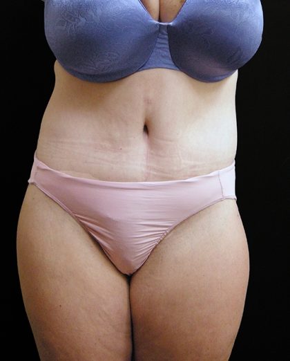 Lower Body Lift Before & After Patient #2285