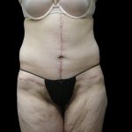 Lower Body Lift Before & After Patient #2305