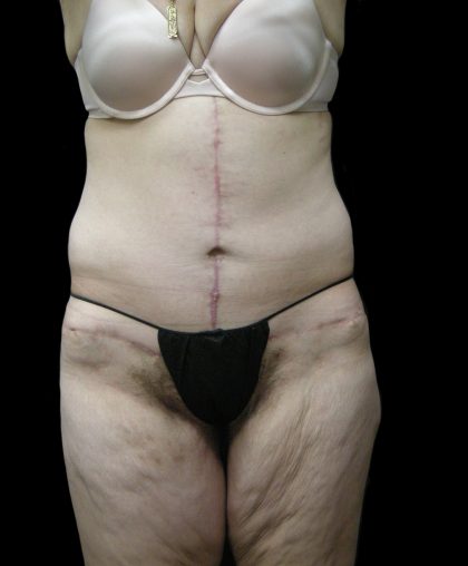 Lower Body Lift Before & After Patient #2305