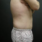 Lower Body Lift Before & After Patient #2269