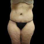 Lower Body Lift Before & After Patient #2316