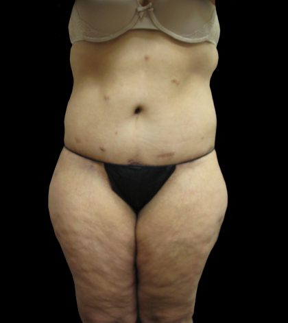 Lower Body Lift Before & After Patient #2316