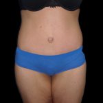 Lower Body Lift Before & After Patient #2278