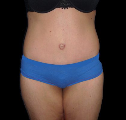 Lower Body Lift Before & After Patient #2278