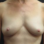 Inverted Nipple Correction Before & After Patient #1872