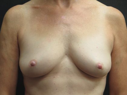 Inverted Nipple Correction Before & After Patient #1872