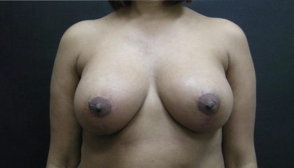 Breast Lift Before & After Patient #1258