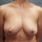 Breast Lift Before & After Patient #1244