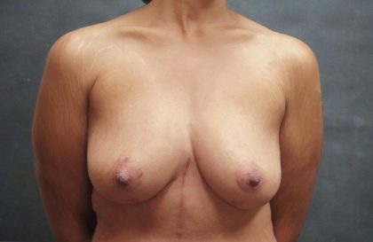 Breast Lift Before & After Patient #1244