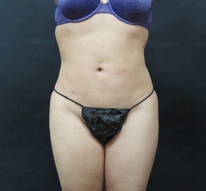 Mommy Makeover Before & After Patient #2596