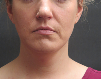 Fat Transfer Before & After Patient #1789