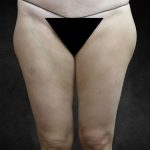 Liposuction Before & After Patient #2013