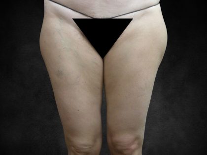 Liposuction Before & After Patient #2013