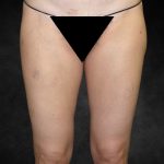 Liposuction Before & After Patient #2013