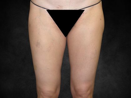Liposuction Before & After Patient #2013