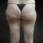 Liposuction Before & After Patient #2013
