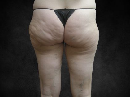 Liposuction Before & After Patient #2013