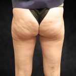 Liposuction Before & After Patient #2013