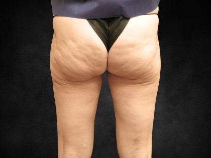 Liposuction Before & After Patient #2013