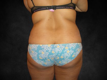 Liposuction Before & After Patient #2016