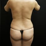 Liposuction Before & After Patient #2021
