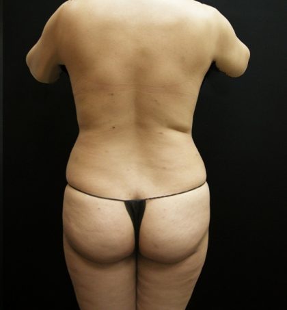 Liposuction Before & After Patient #2021