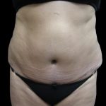 Liposuction Before & After Patient #2026