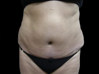 Liposuction Before & After Patient #2026