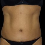 Liposuction Before & After Patient #2026