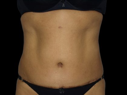Liposuction Before & After Patient #2026