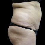 Liposuction Before & After Patient #2026