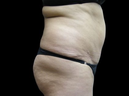Liposuction Before & After Patient #2026