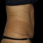 Liposuction Before & After Patient #2026