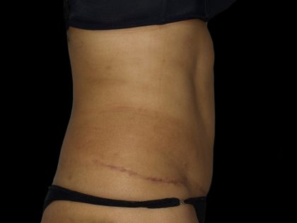 Liposuction Before & After Patient #2026