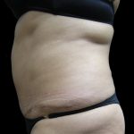 Liposuction Before & After Patient #2026