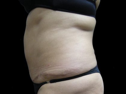 Liposuction Before & After Patient #2026