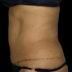 Liposuction Before & After Patient #2026