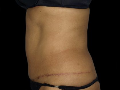 Liposuction Before & After Patient #2026