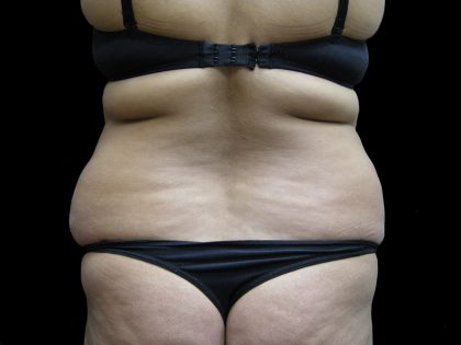Liposuction Before & After Patient #2026