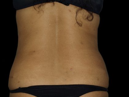 Liposuction Before & After Patient #2026