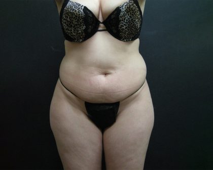 Liposuction Before & After Patient #2033